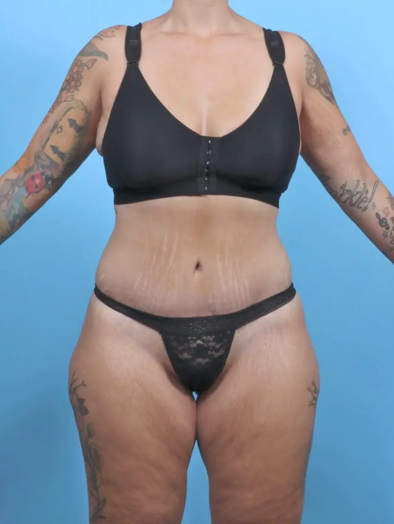 Tummy Tuck - Case 51345 - After