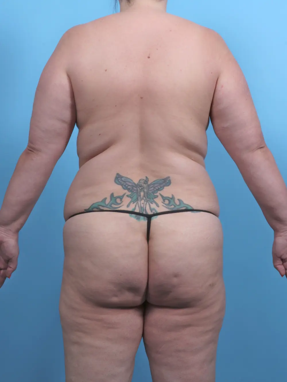 Breast Lift/Reduction with Implants Patient Photo - Case 51371 - before view-3