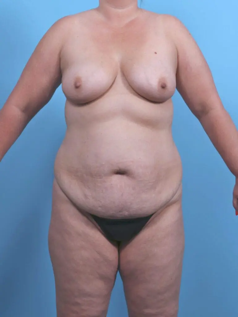 Breast Lift/Reduction with Implants - Case 51371 - Before