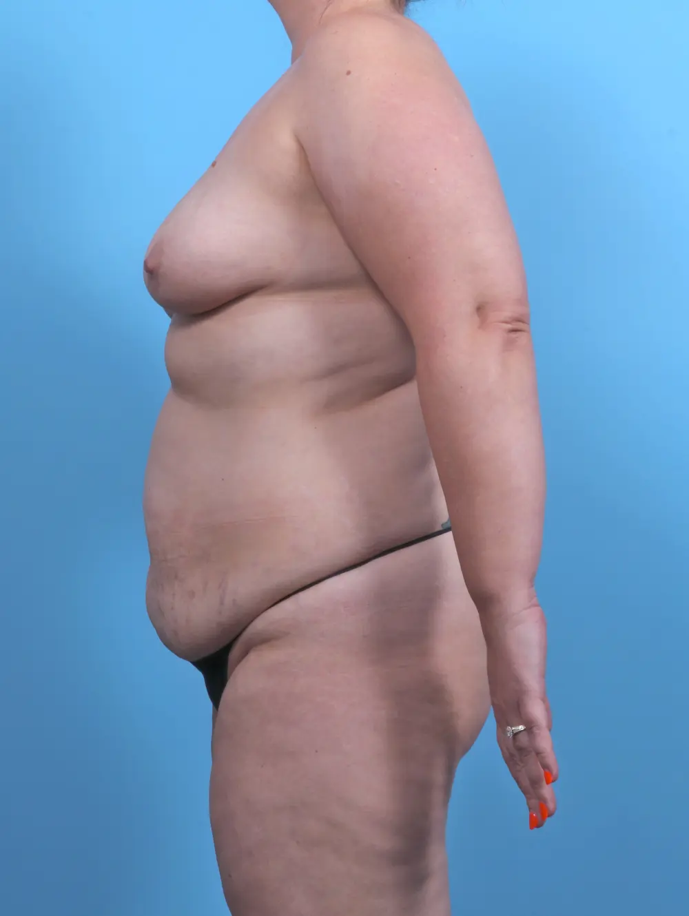 Breast Lift/Reduction with Implants Patient Photo - Case 51371 - before view-2