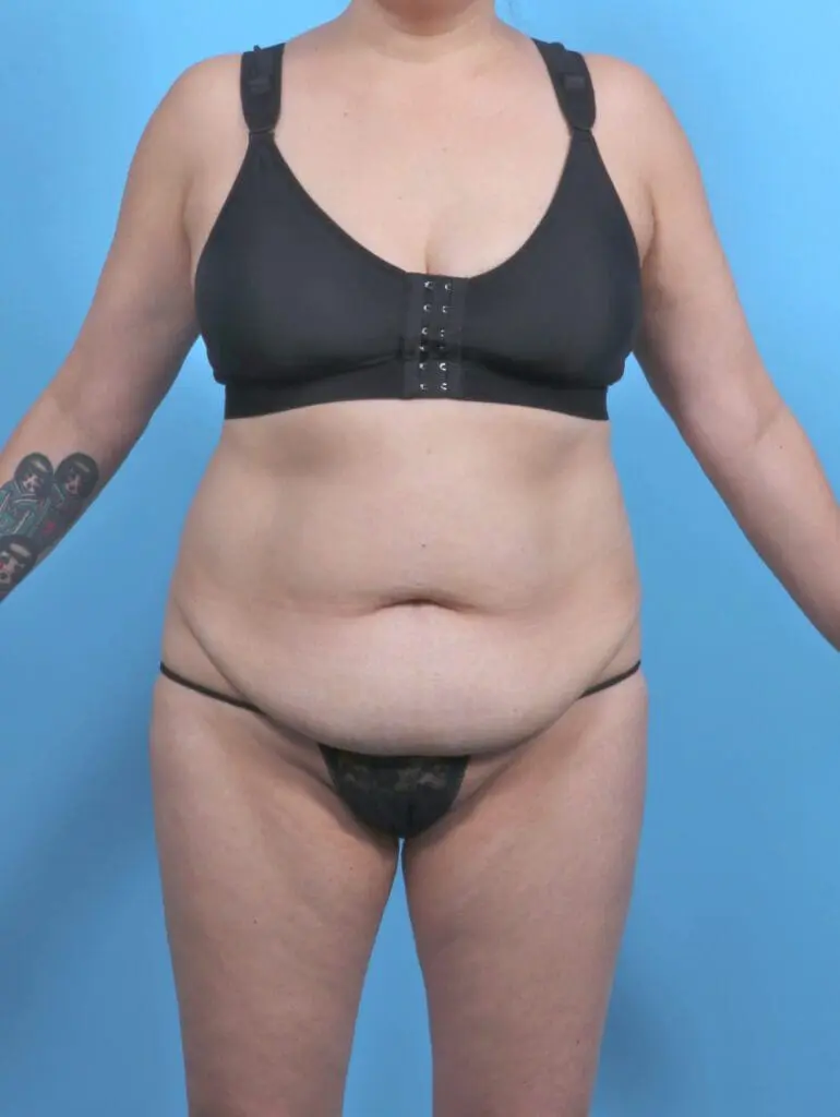 Tummy Tuck - Case 51397 - Before