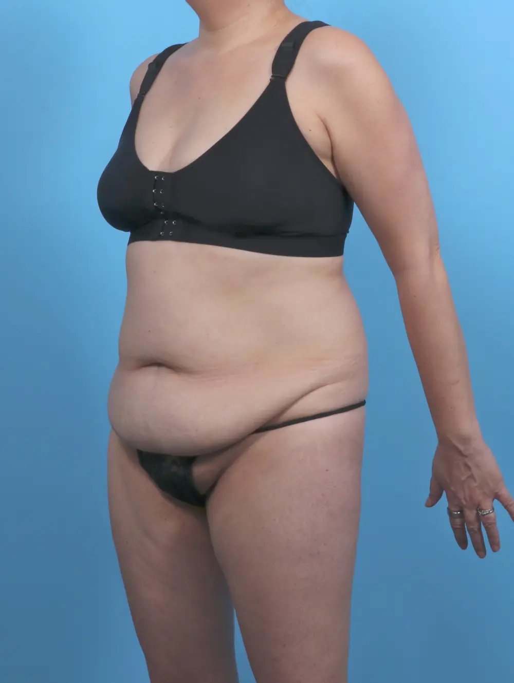 Tummy Tuck Patient Photo - Case 51397 - before view-1