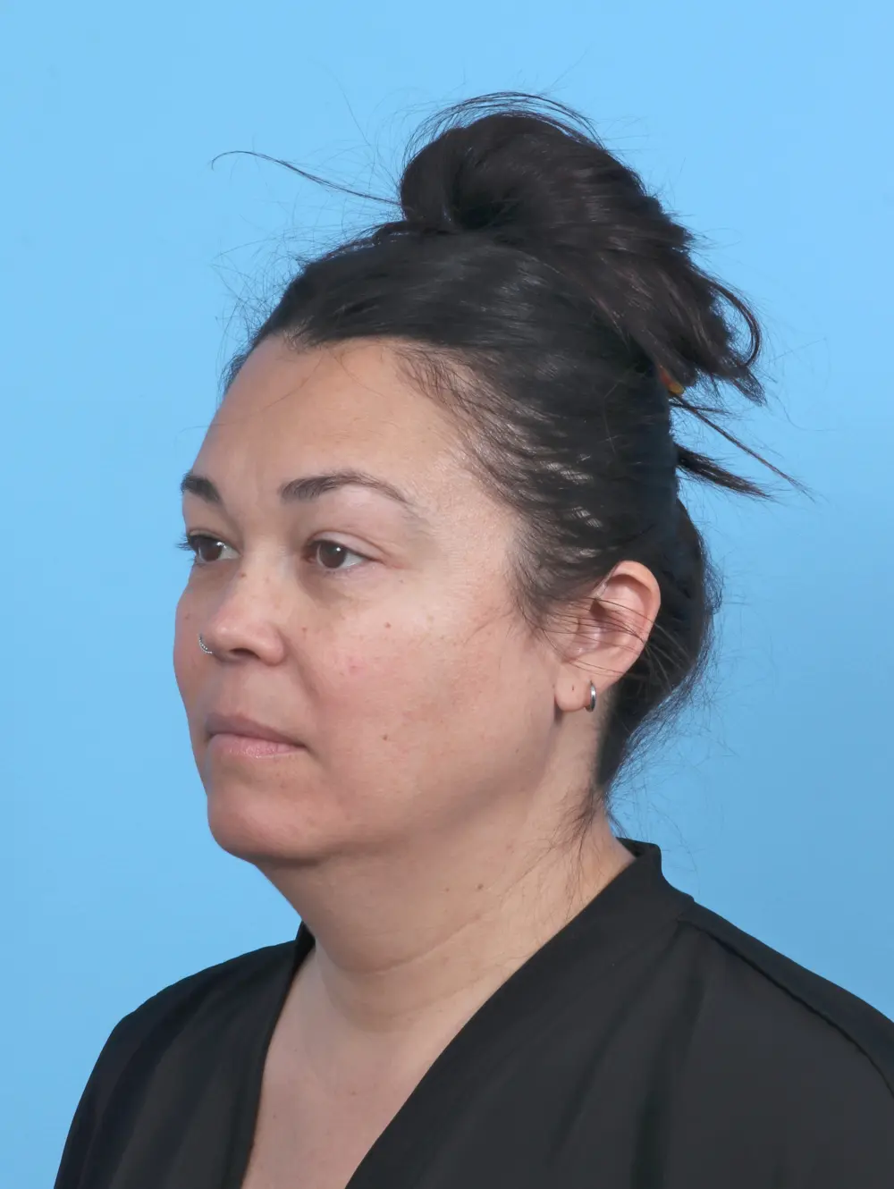 Liposuction Patient Photo - Case 51381 - before view-1