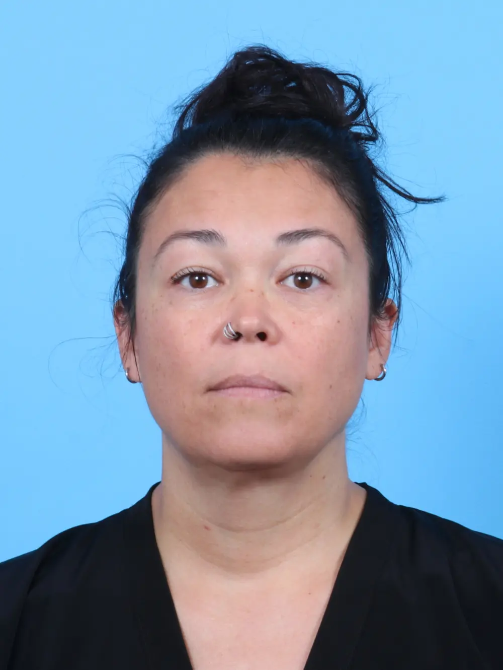 Liposuction Patient Photo - Case 51381 - after view-2