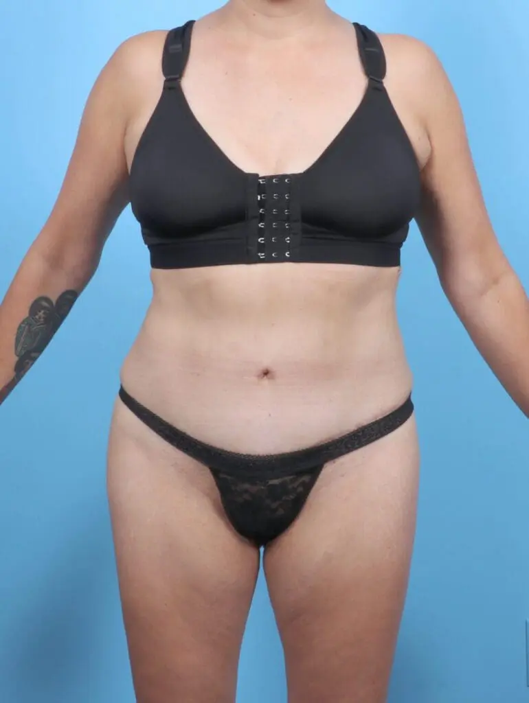 Tummy Tuck - Case 51397 - After
