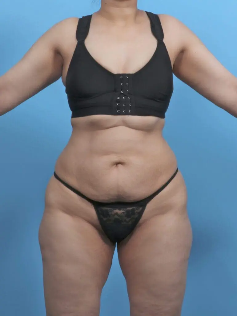 Tummy Tuck - Case 51459 - Before