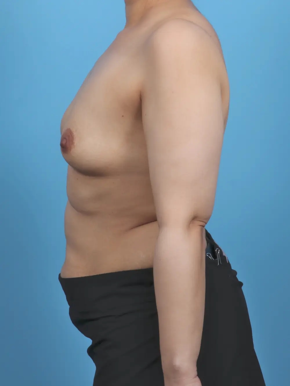 Breast Augmentation Patient Photo - Case 51475 - before view-2