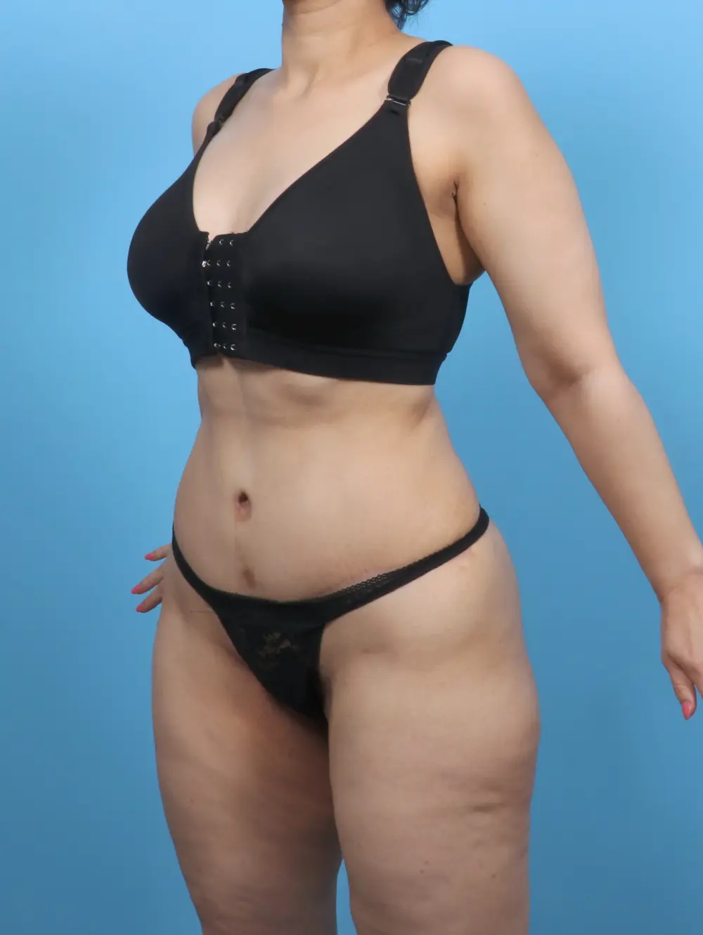 Tummy Tuck Patient Photo - Case 51459 - after view-1