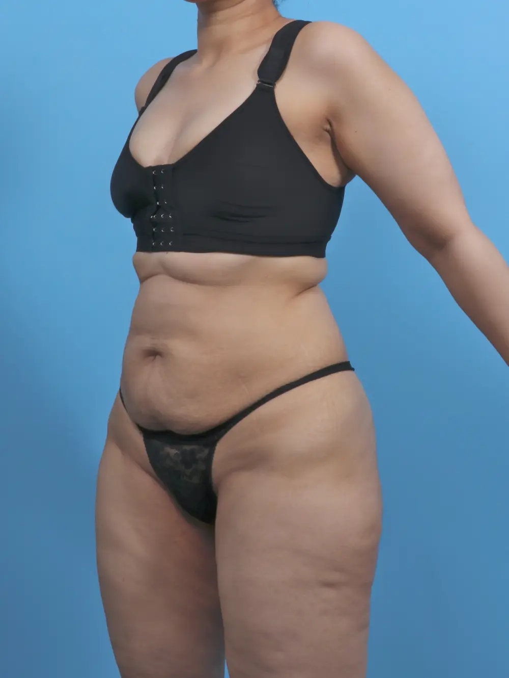 Tummy Tuck Patient Photo - Case 51459 - before view-1