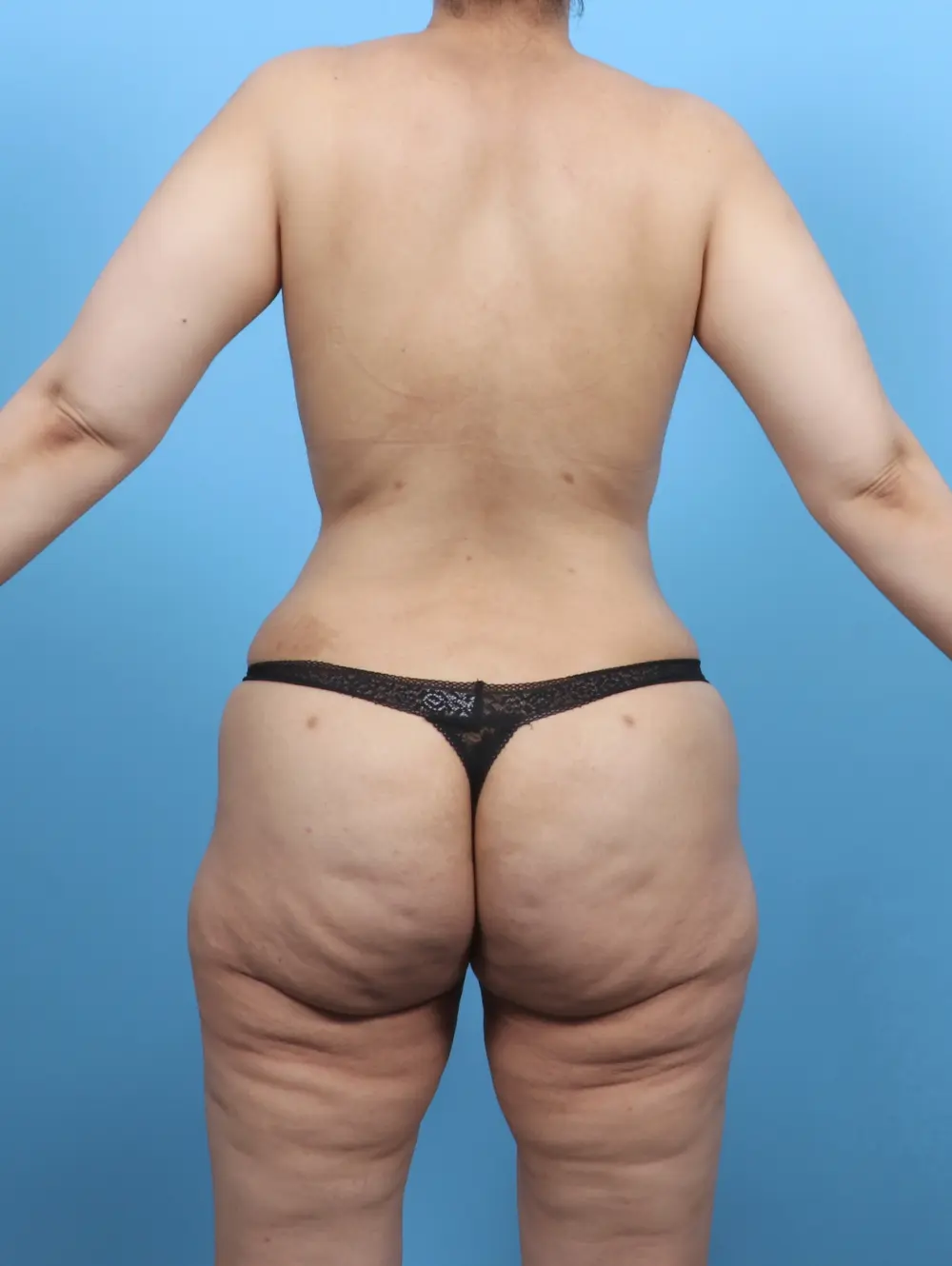 Tummy Tuck Patient Photo - Case 51459 - after view-3