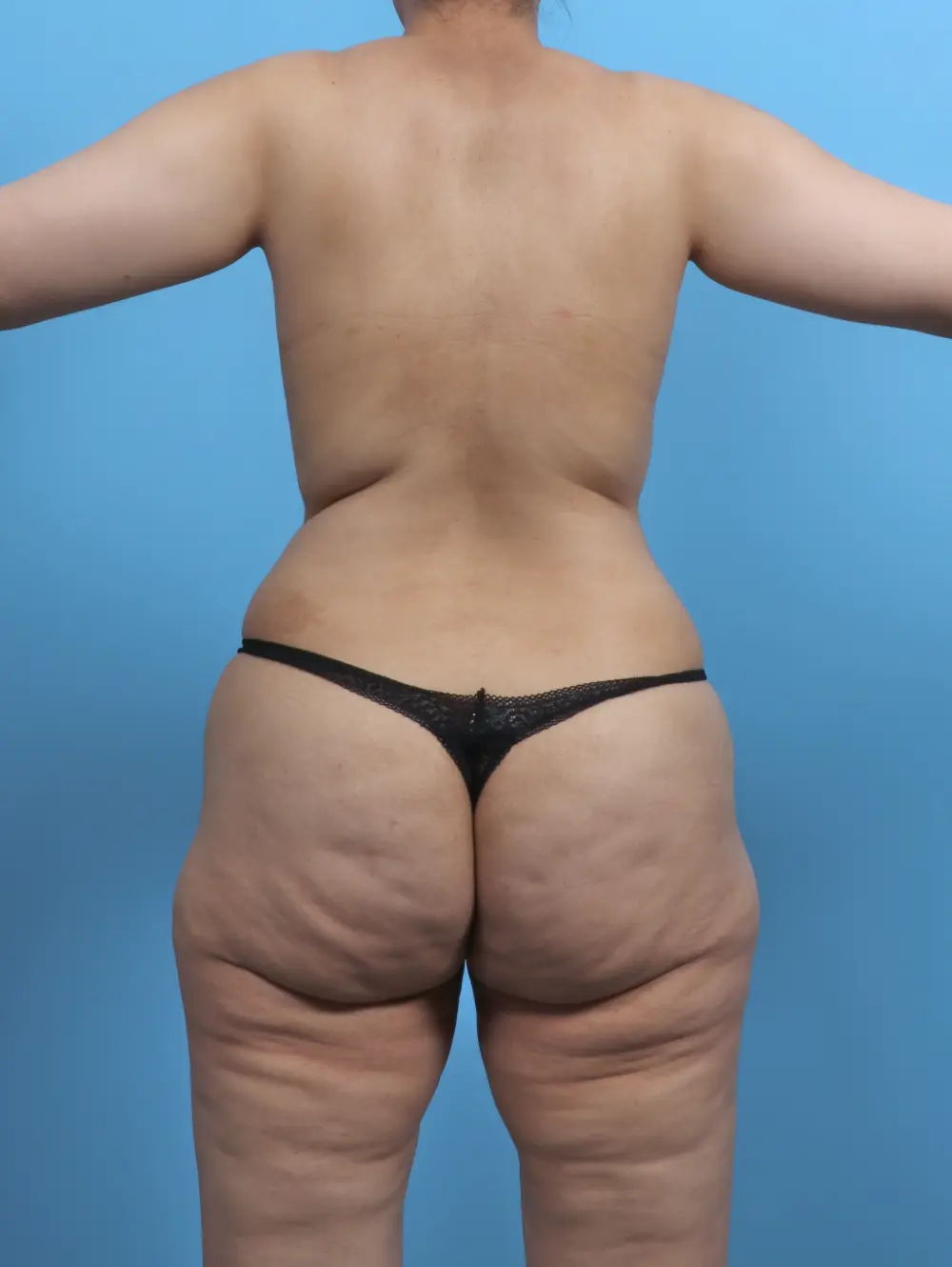 Tummy Tuck Patient Photo - Case 51459 - before view-3