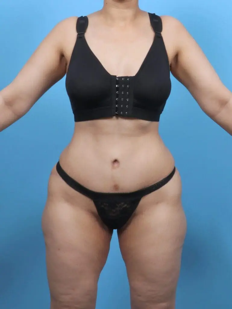 Tummy Tuck - Case 51459 - After