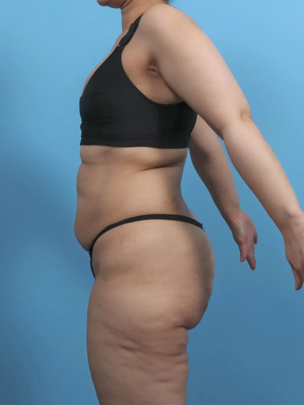 Tummy Tuck Patient Photo - Case 51459 - before view-2