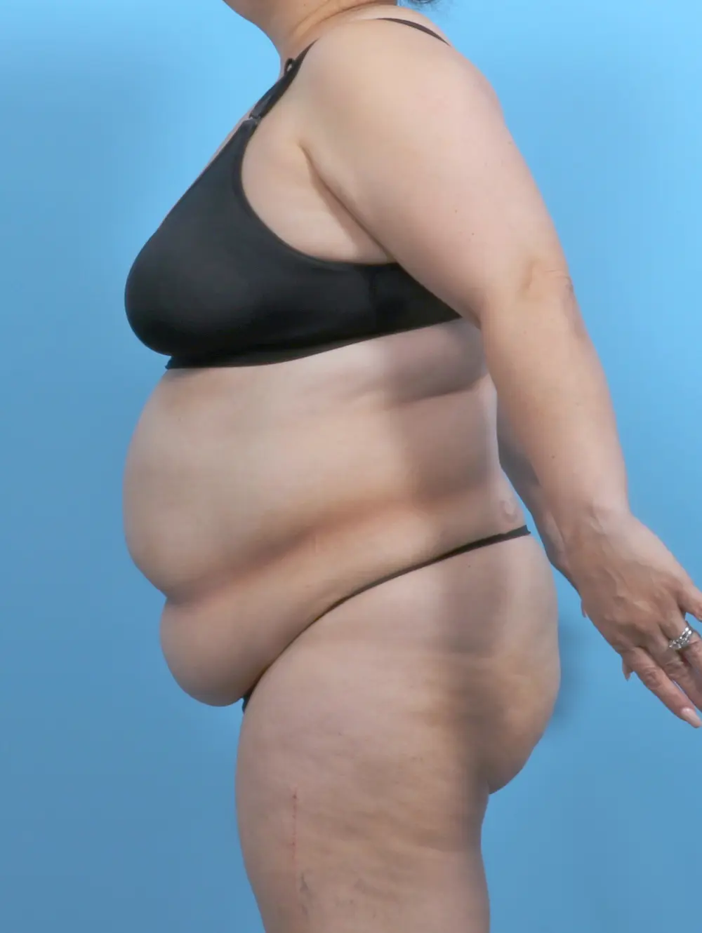 Tummy Tuck Patient Photo - Case 51493 - before view-2