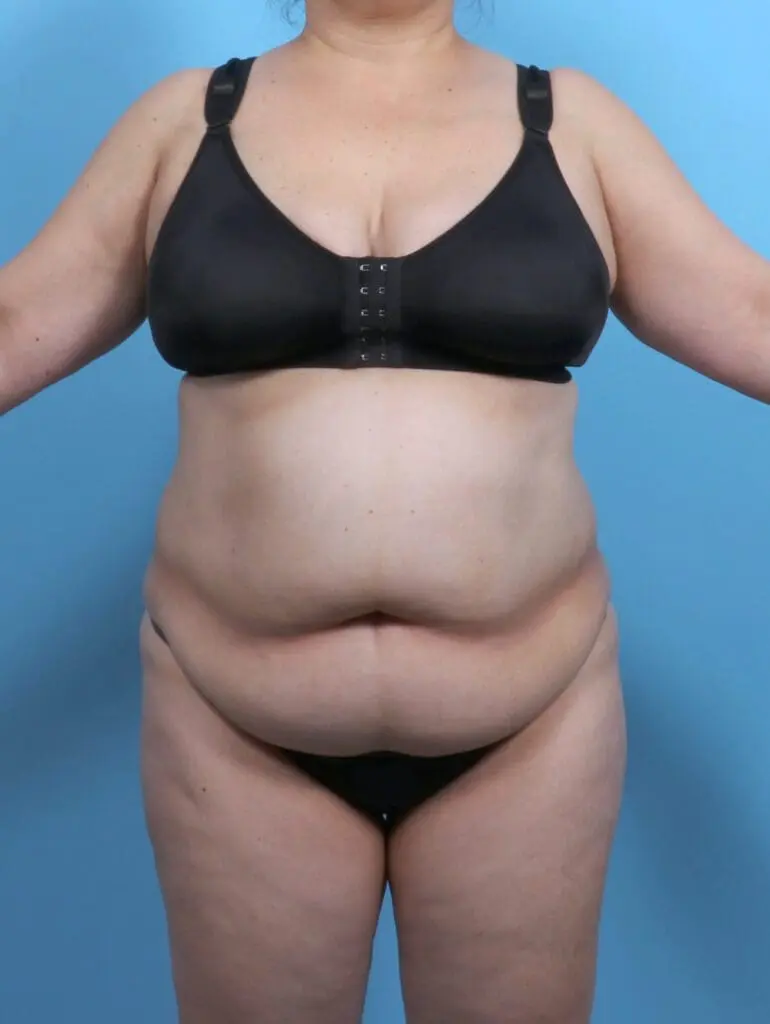 Tummy Tuck - Case 51493 - Before