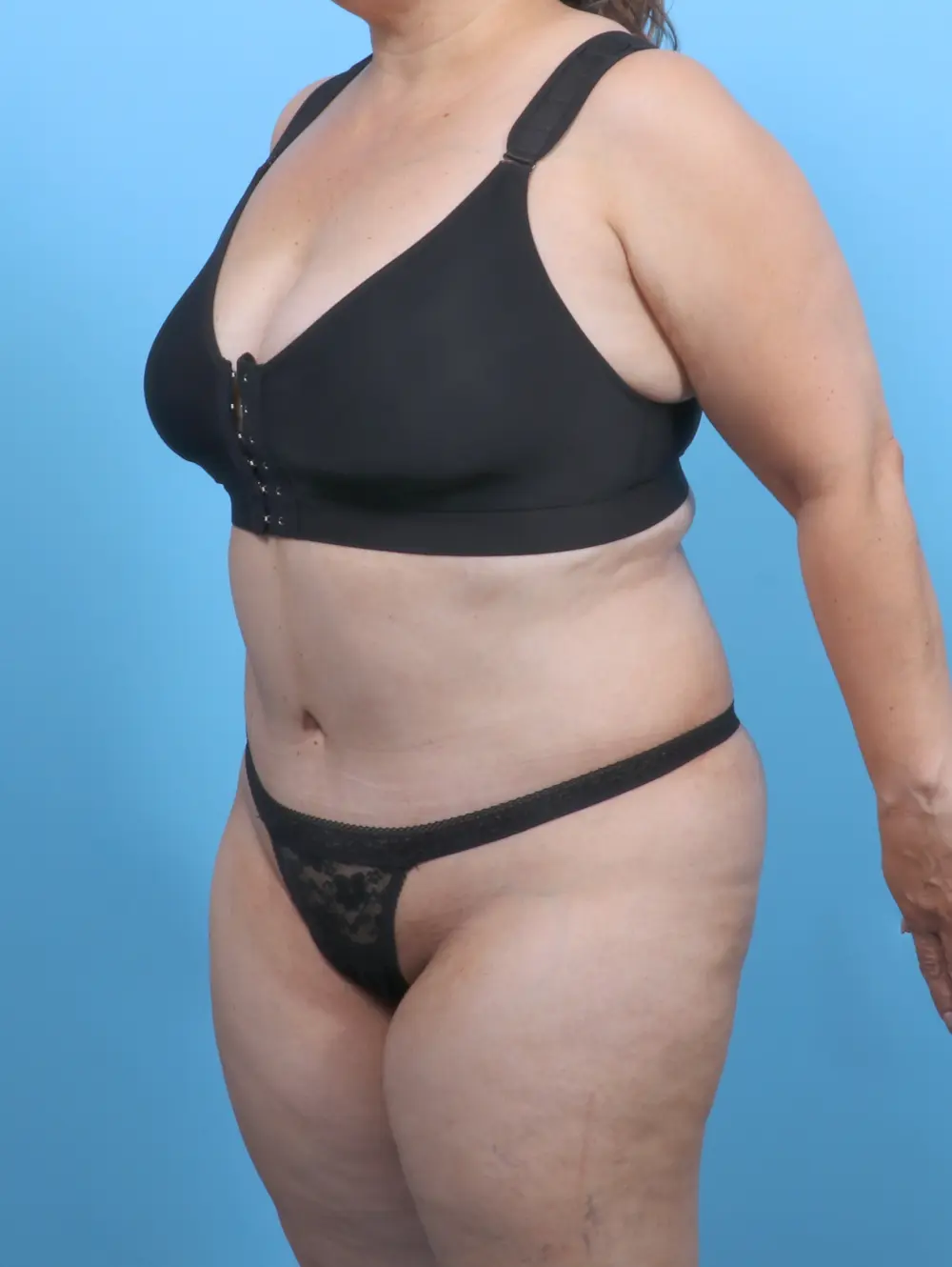 Tummy Tuck Patient Photo - Case 51493 - after view-1