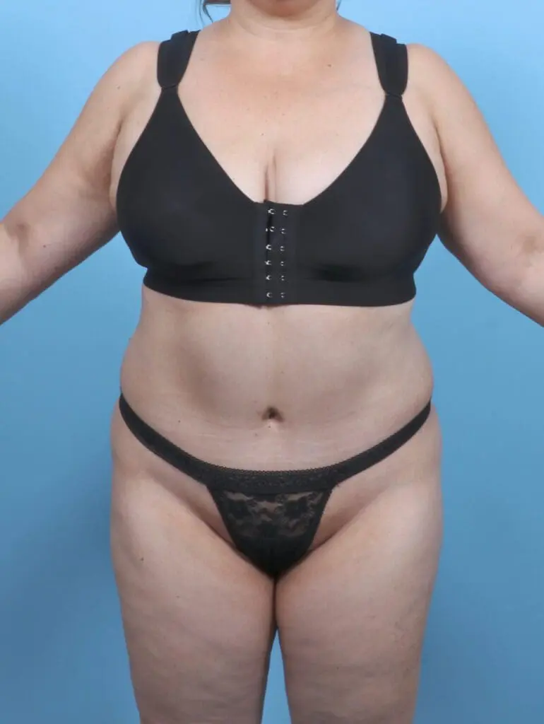 Tummy Tuck - Case 51493 - After