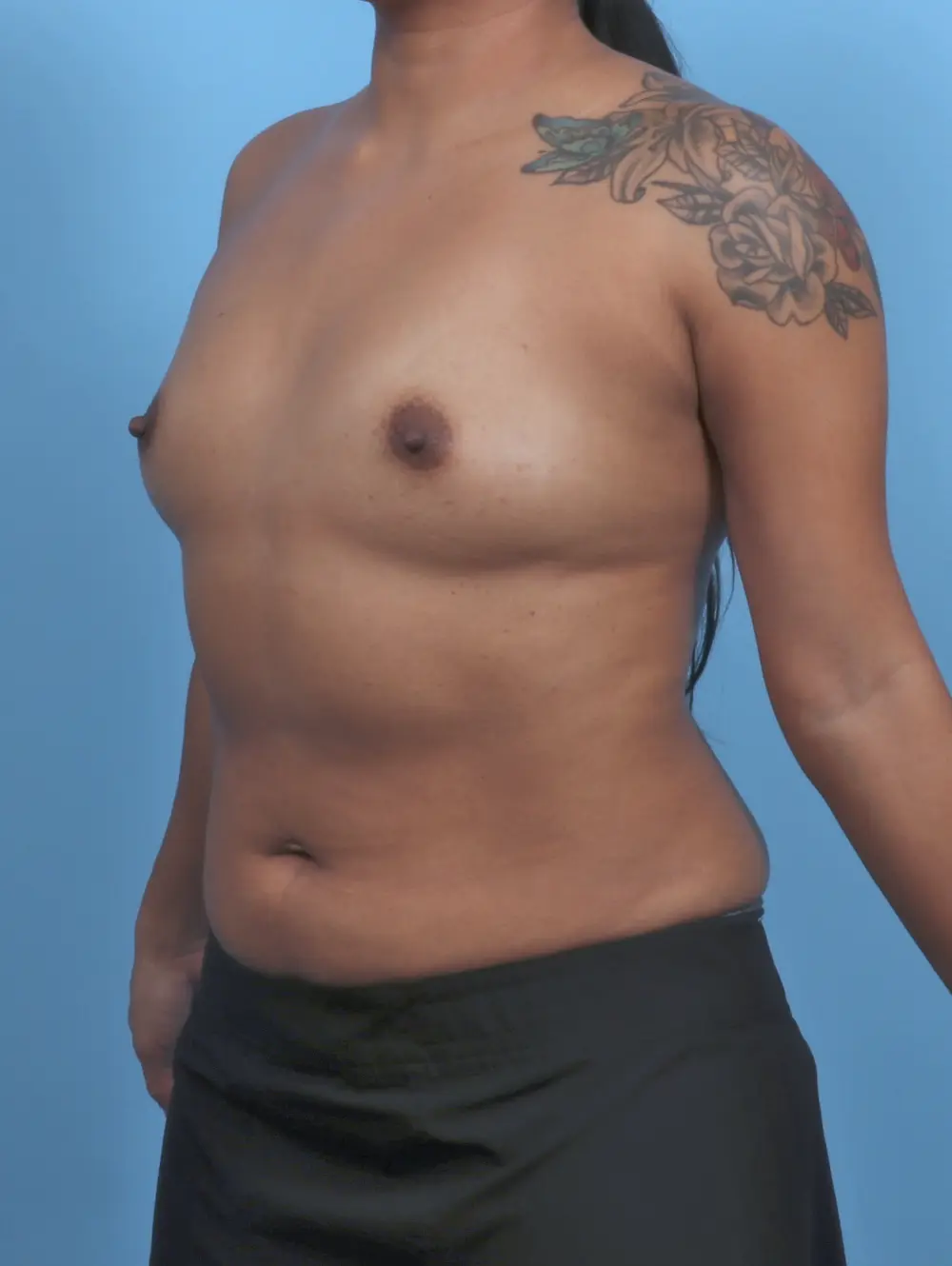 Breast Augmentation Patient Photo - Case 51501 - before view-1