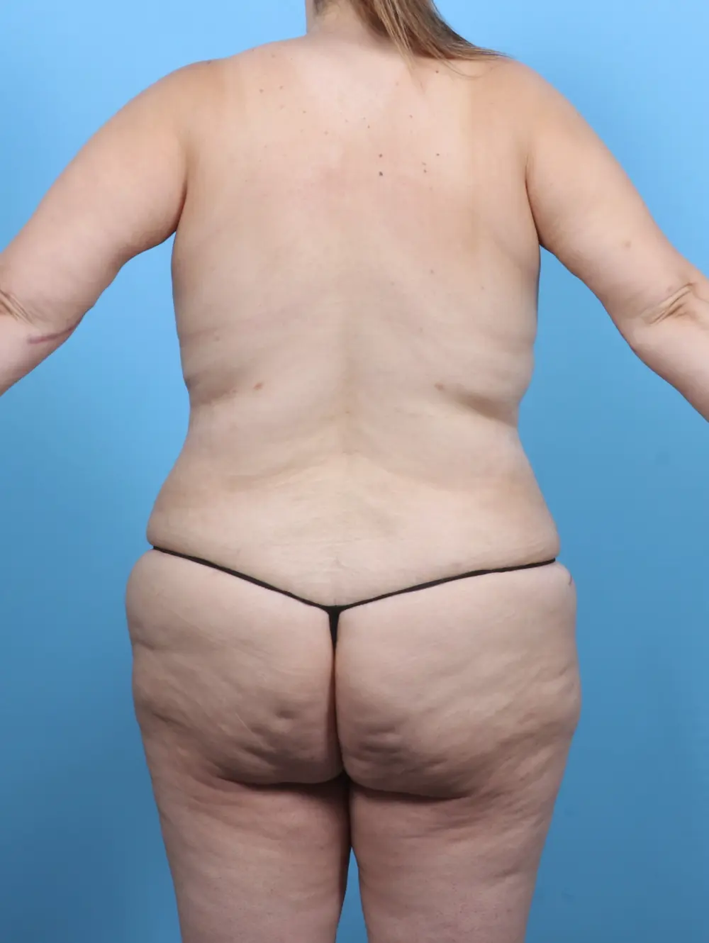 Breast Lift/Reduction with Implants Patient Photo - Case 51509 - after view-3