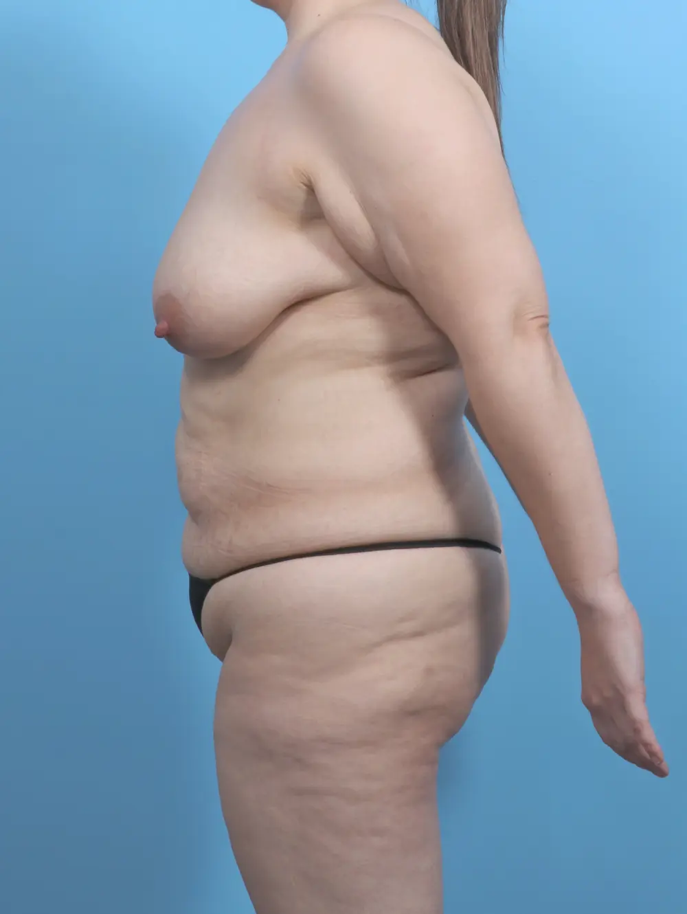 Breast Lift/Reduction with Implants Patient Photo - Case 51509 - before view-2