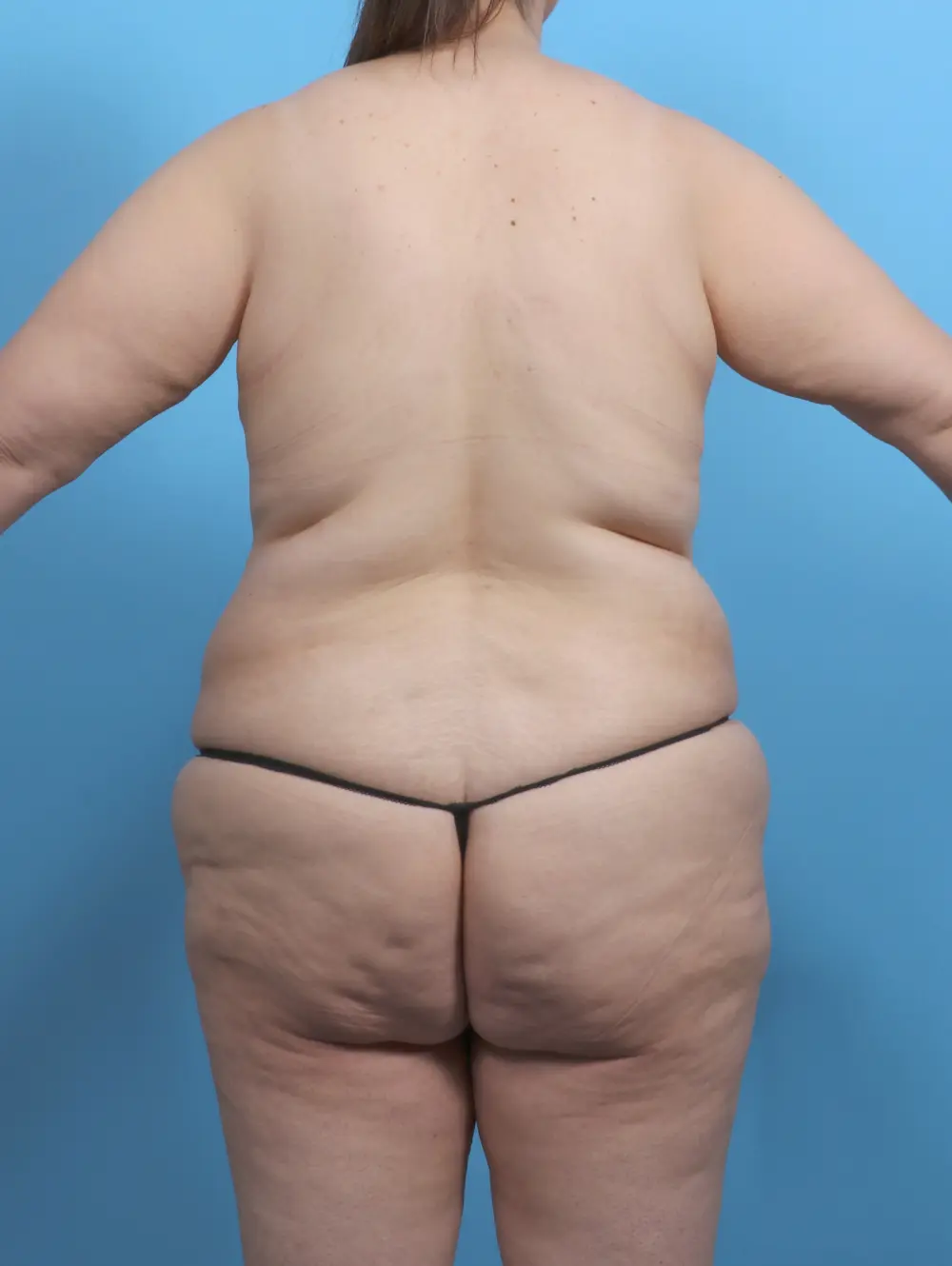 Breast Lift/Reduction with Implants Patient Photo - Case 51509 - before view-3