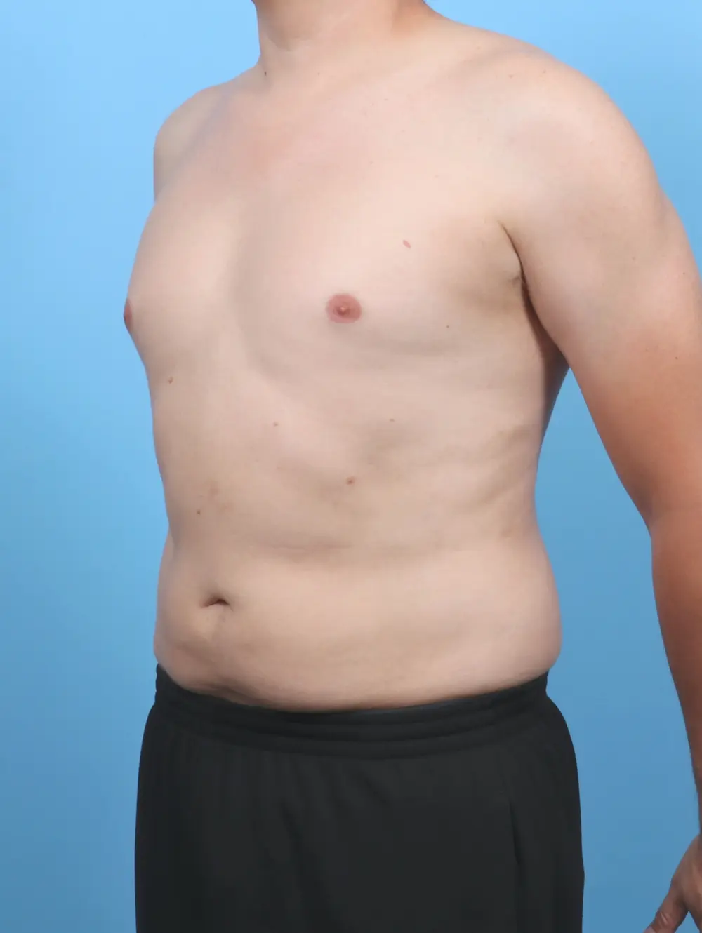 Liposuction Patient Photo - Case 51597 - after view-1