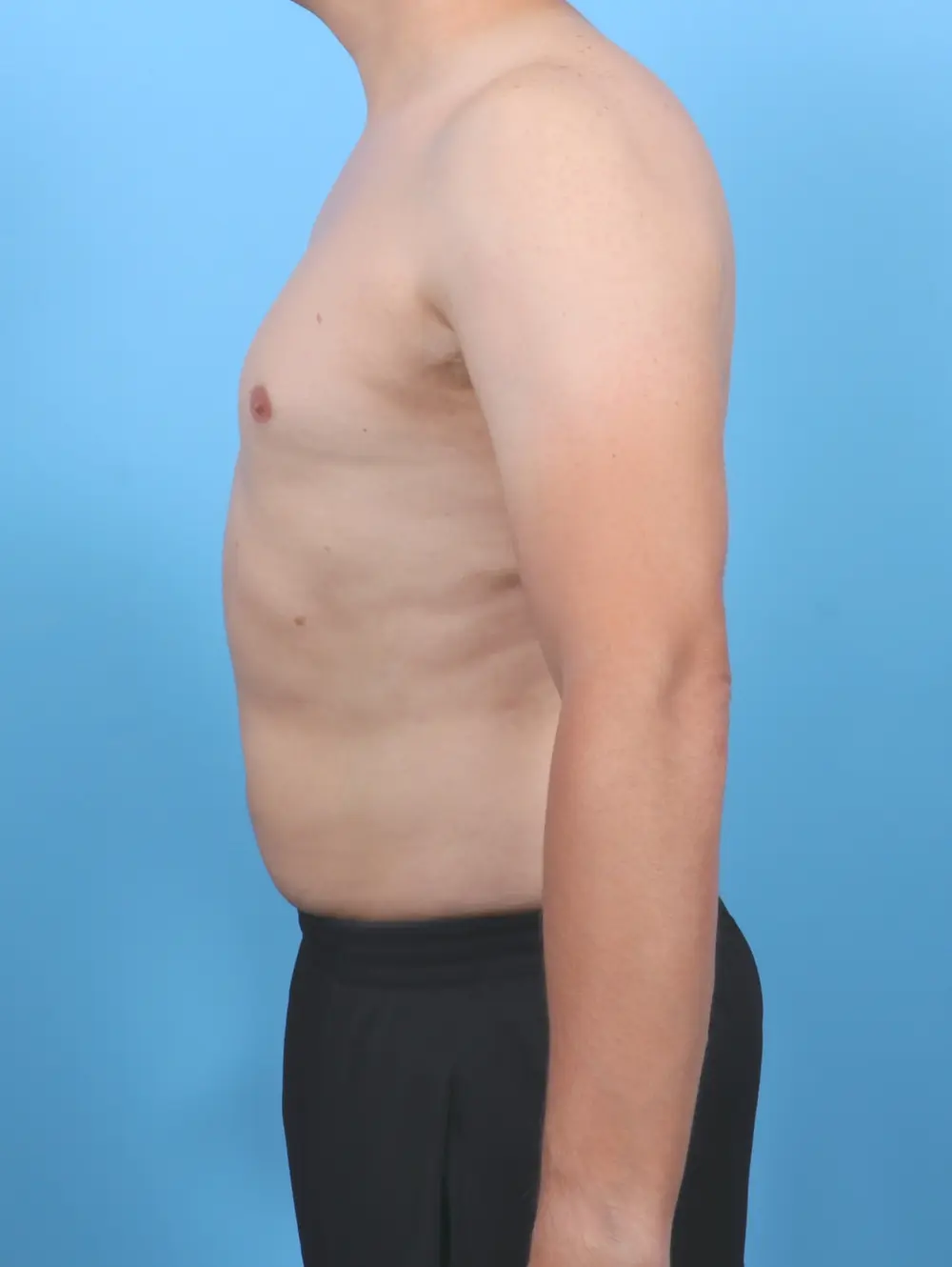 Liposuction Patient Photo - Case 51597 - after view-2