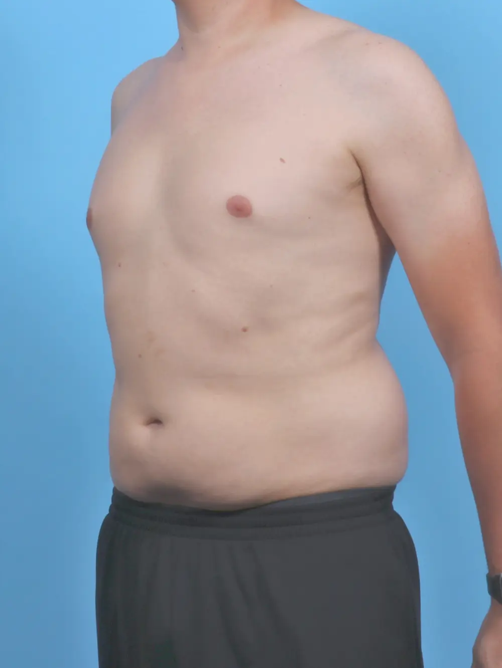 Liposuction Patient Photo - Case 51597 - before view-1