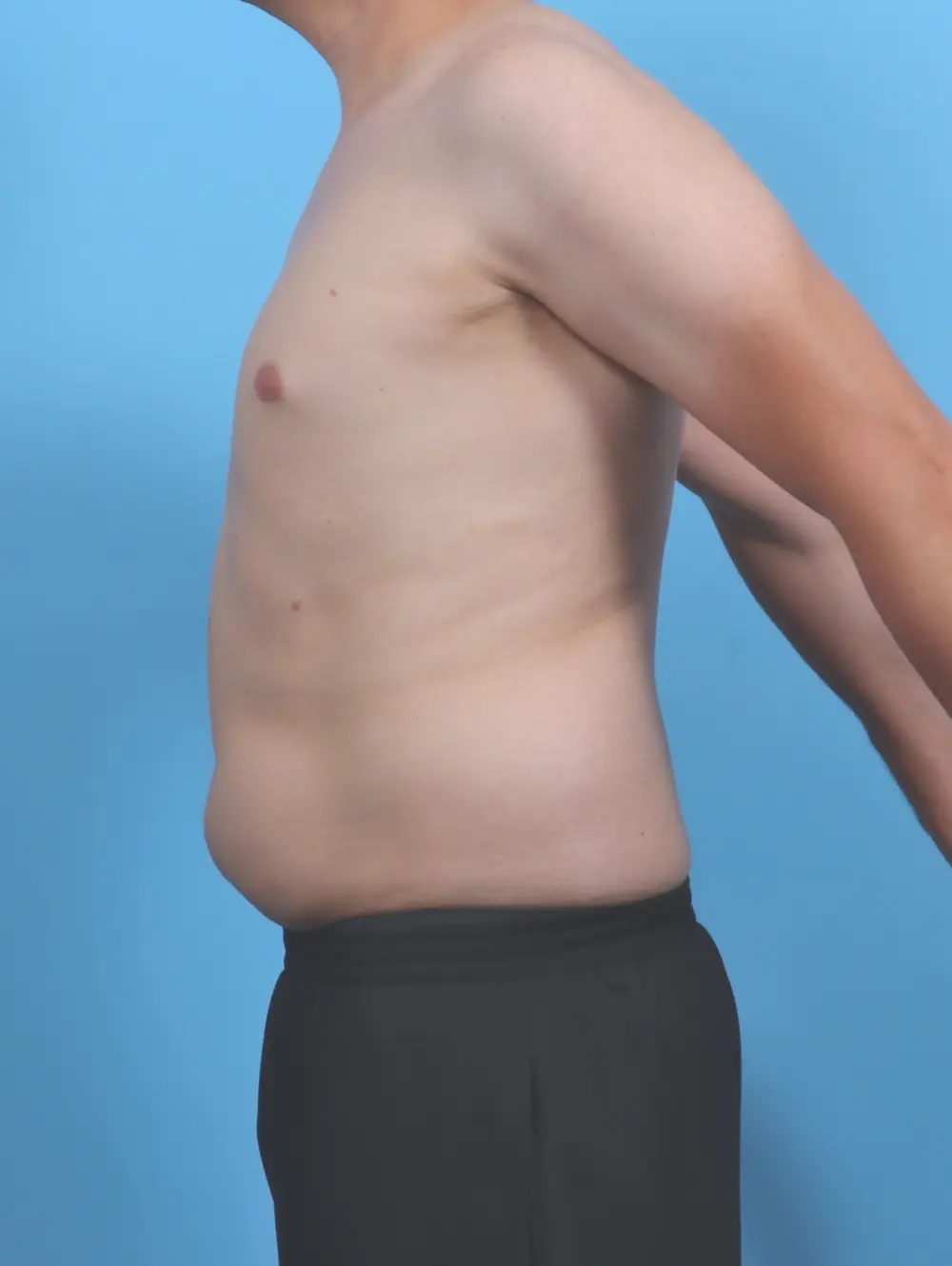 Liposuction Patient Photo - Case 51597 - before view-2