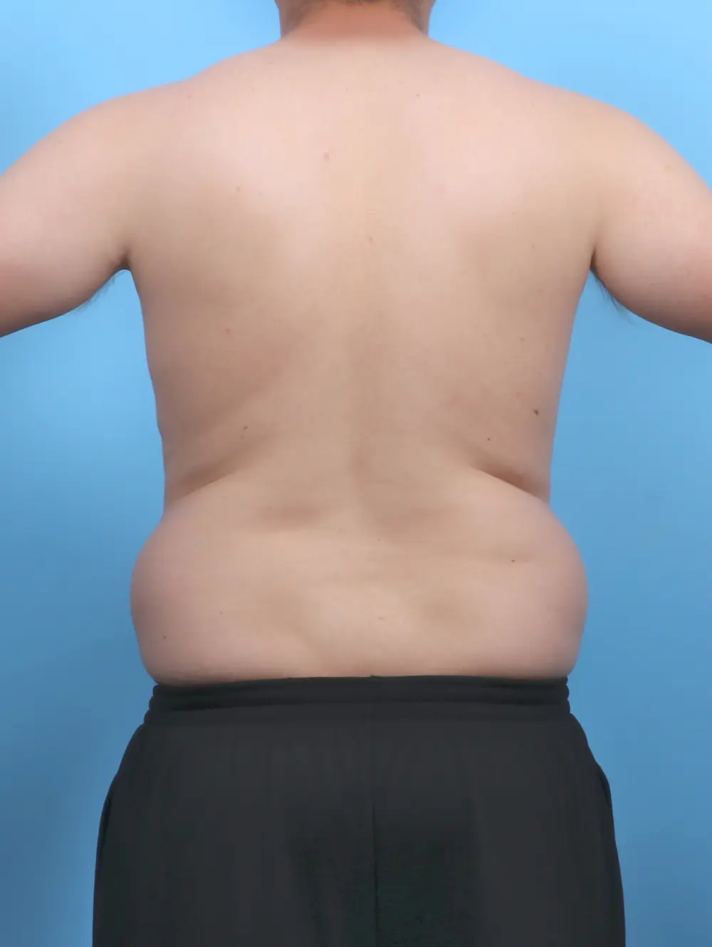 Liposuction Patient Photo - Case 51597 - before view-3