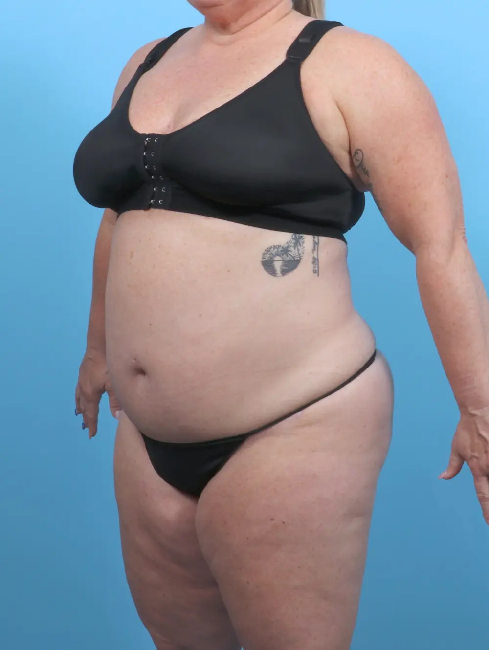 After Weight Loss Patient Photo - Case 51615 - after view-1