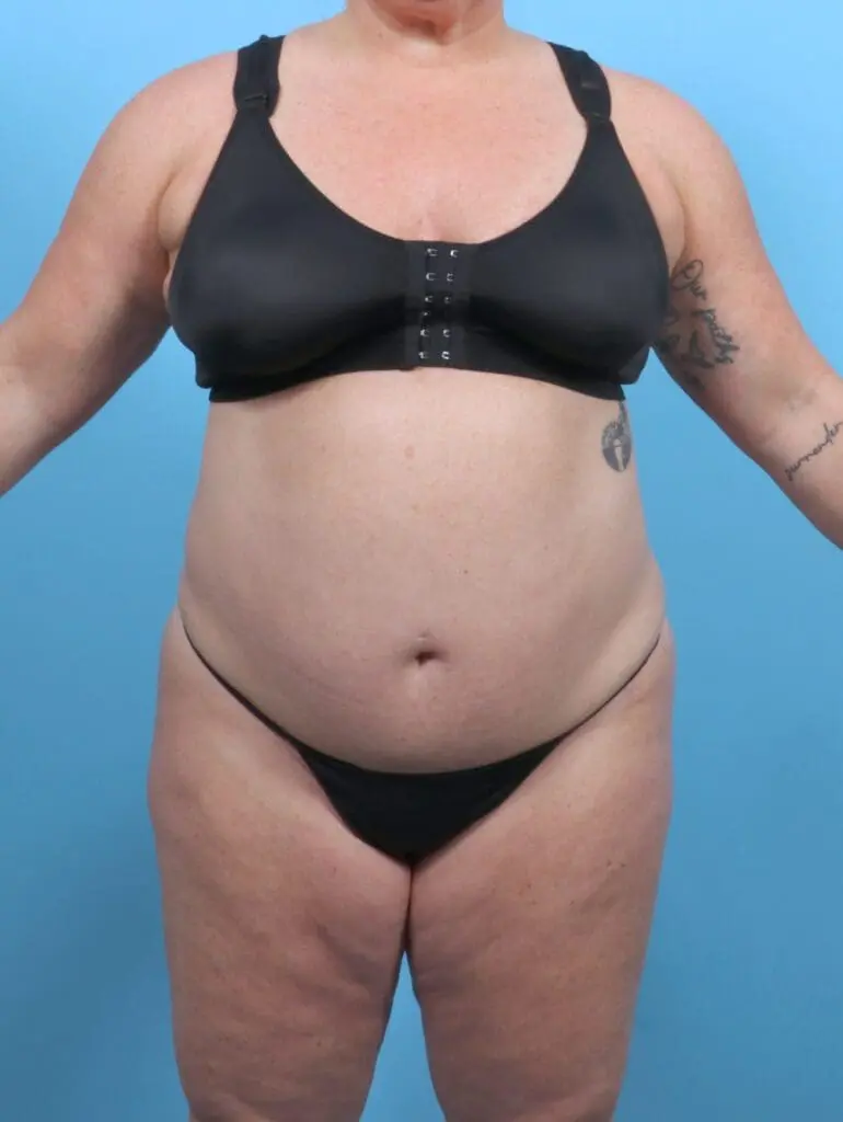 After Weight Loss - Case 51615 - After