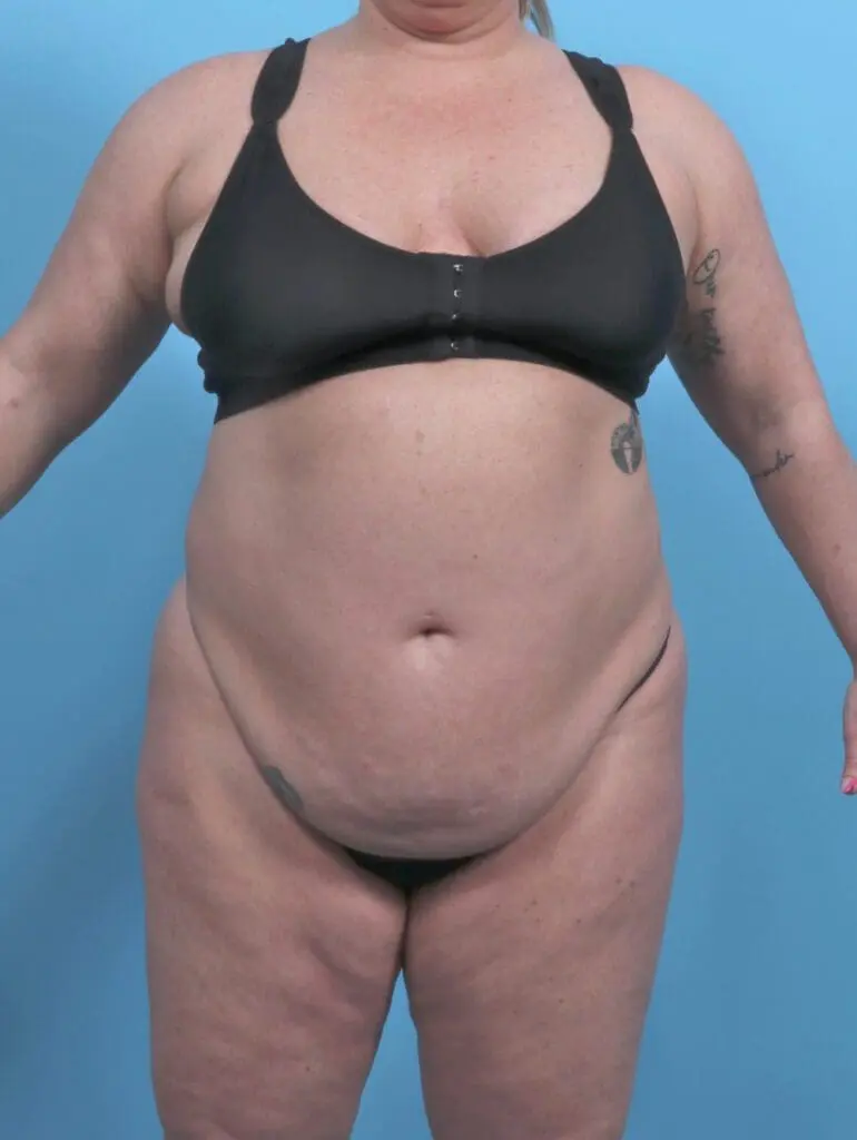 After Weight Loss - Case 51615 - Before