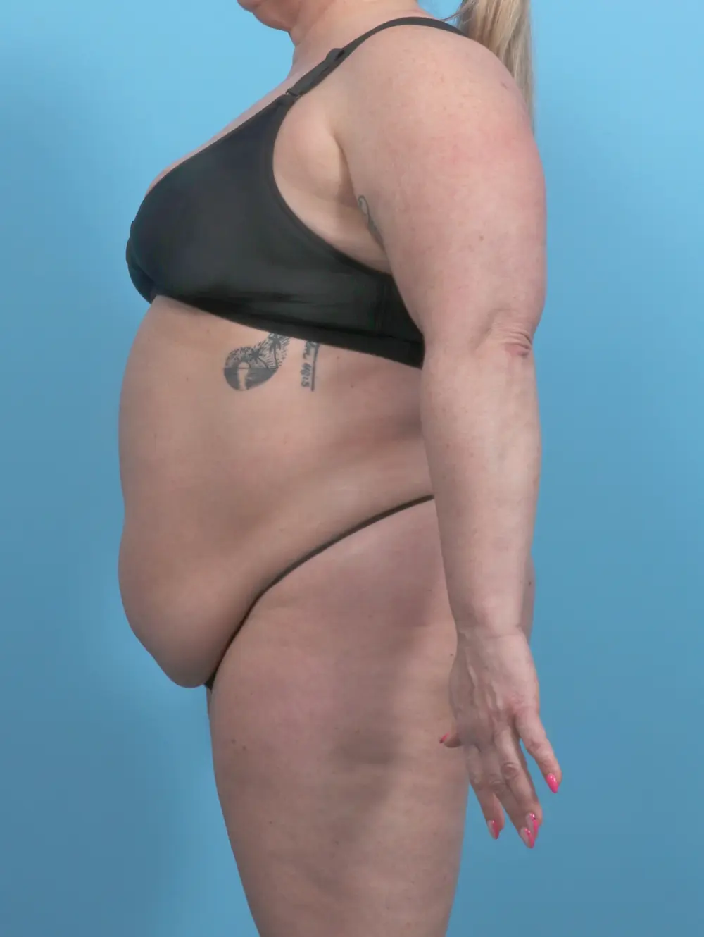 After Weight Loss Patient Photo - Case 51615 - before view-2