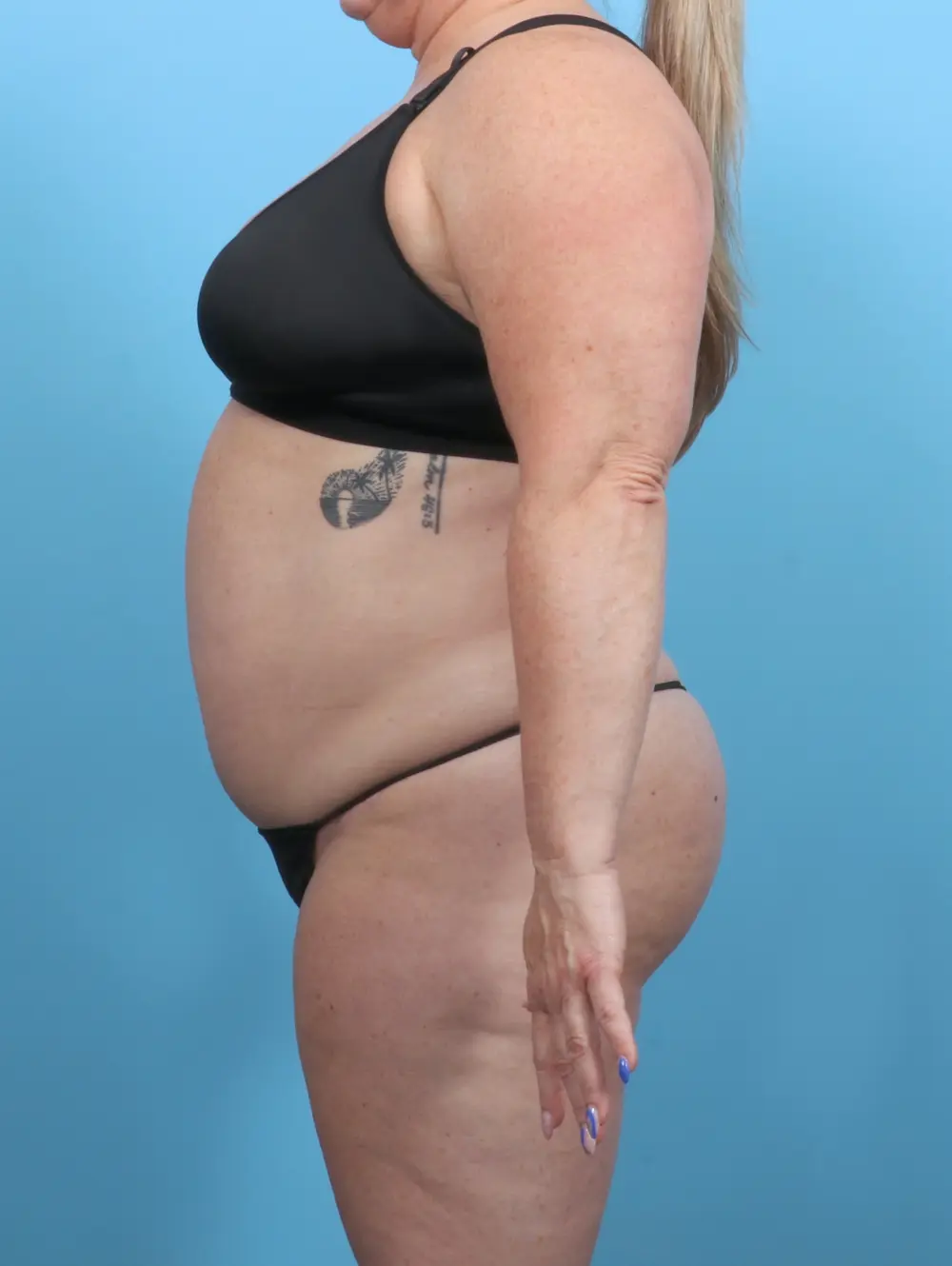 After Weight Loss Patient Photo - Case 51615 - after view-2
