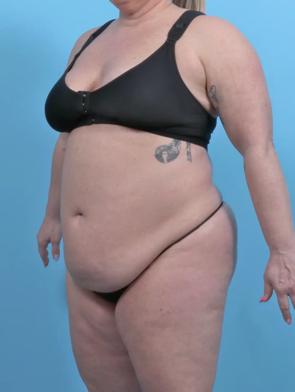 After Weight Loss Patient Photo - Case 51615 - before view-1