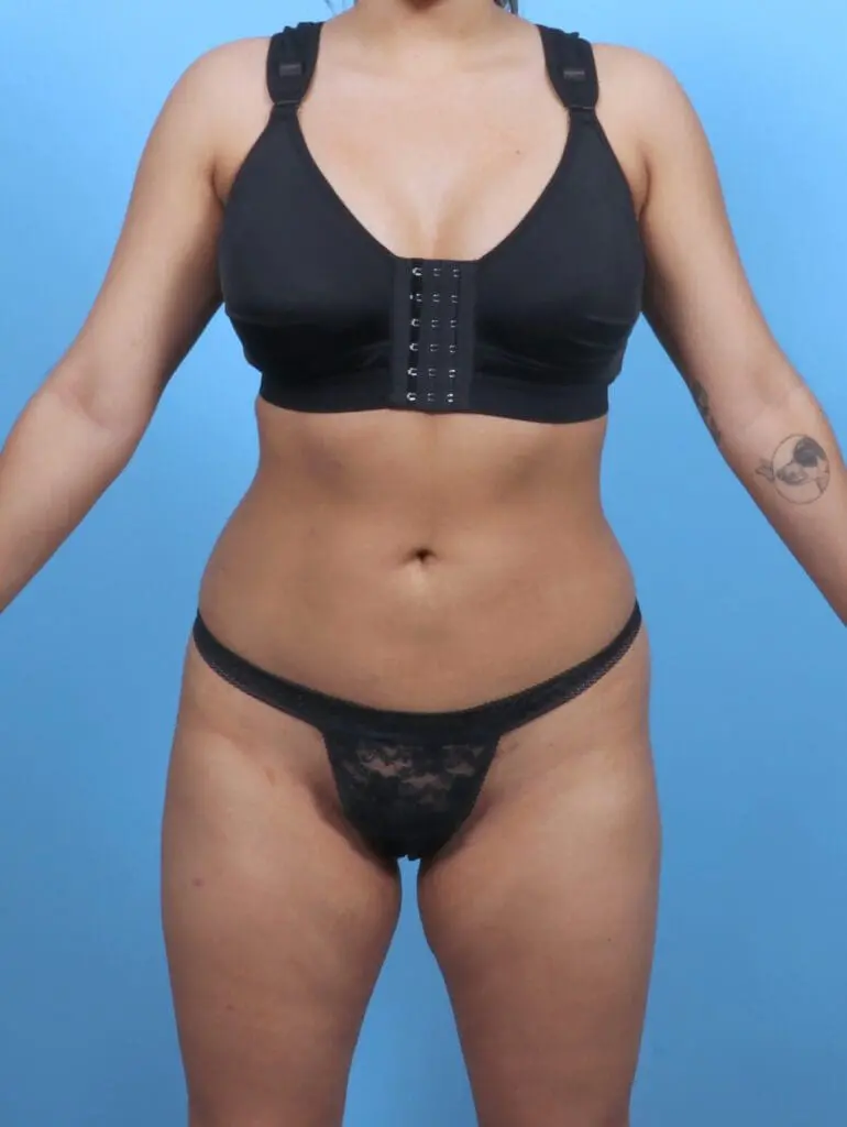 Liposuction - Case 51624 - After