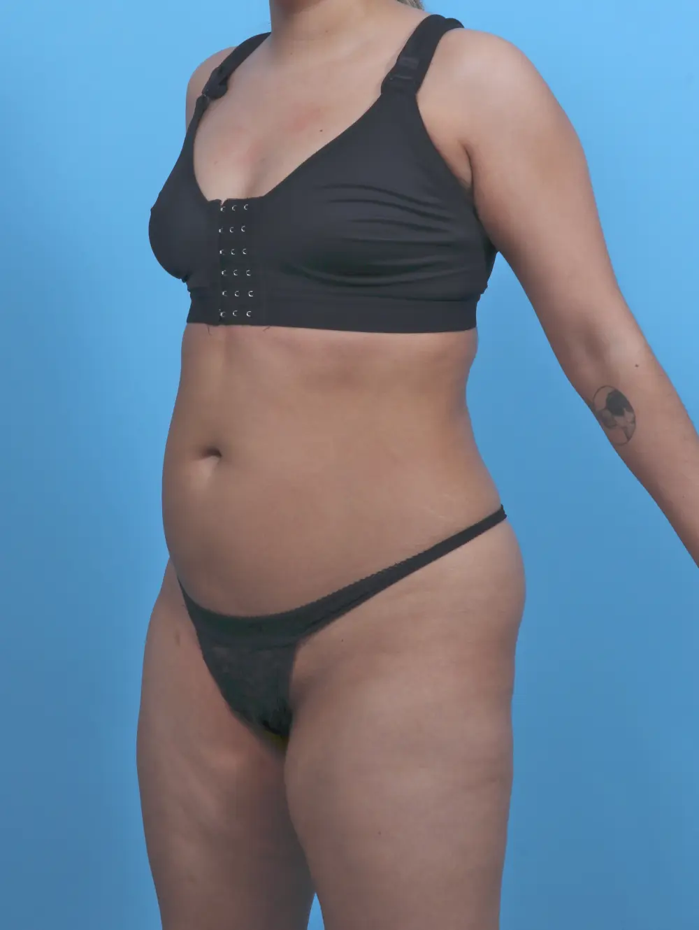 Liposuction Patient Photo - Case 51624 - before view-1