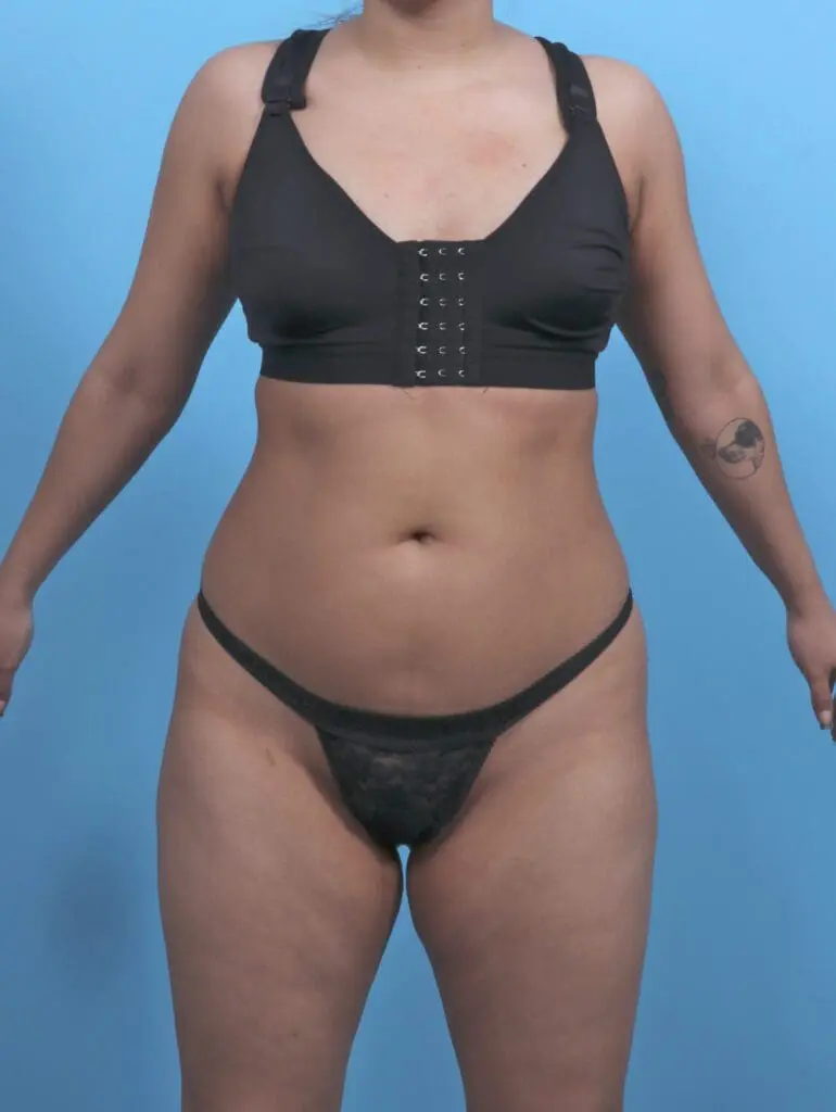 Liposuction - Case 51624 - Before