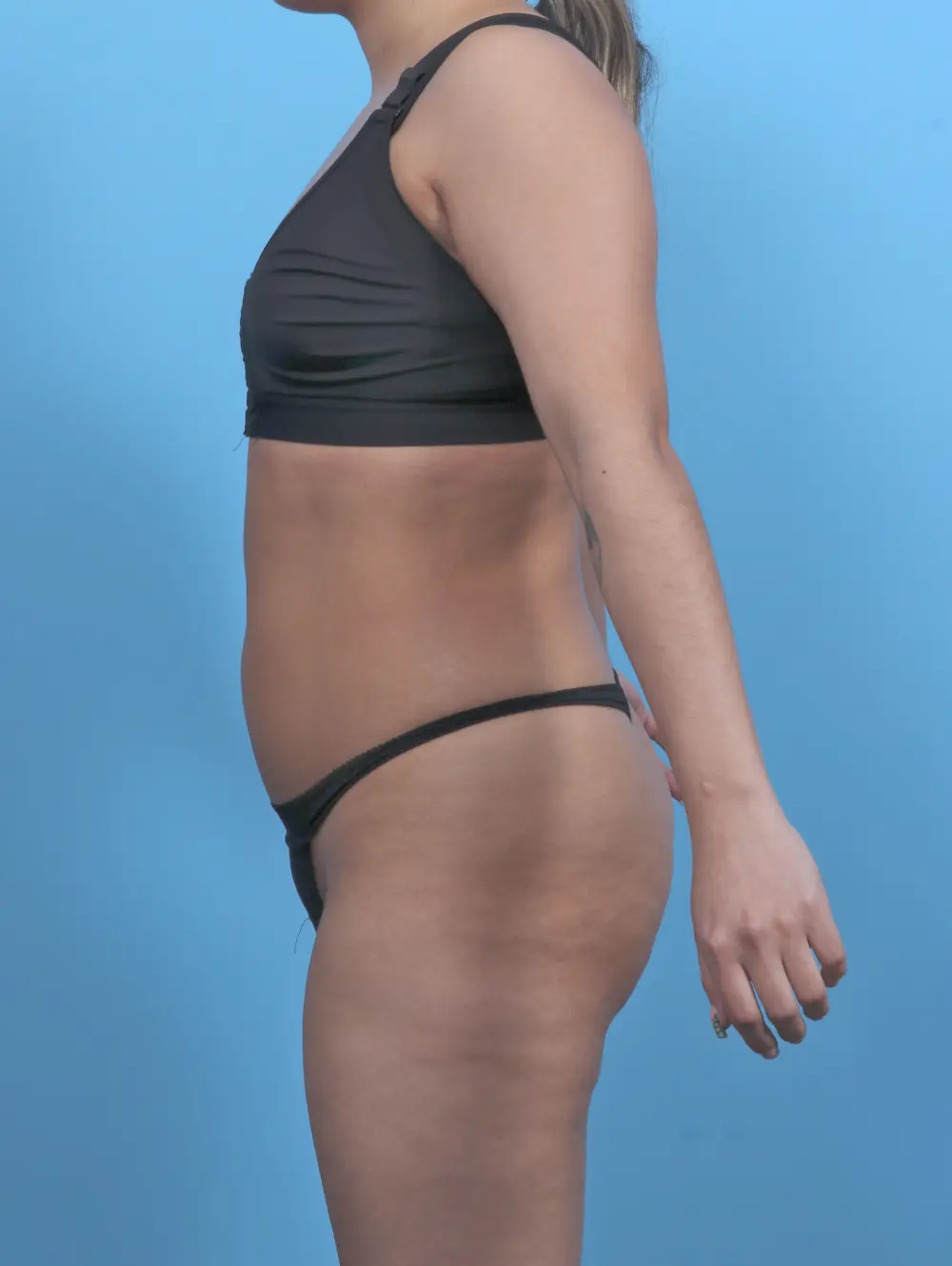 Liposuction Patient Photo - Case 51624 - before view-2