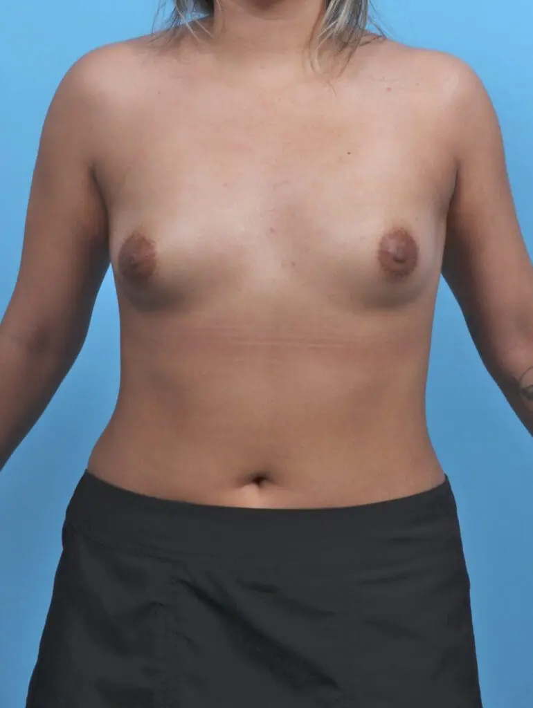 Breast Augmentation - Case 51632 - Before