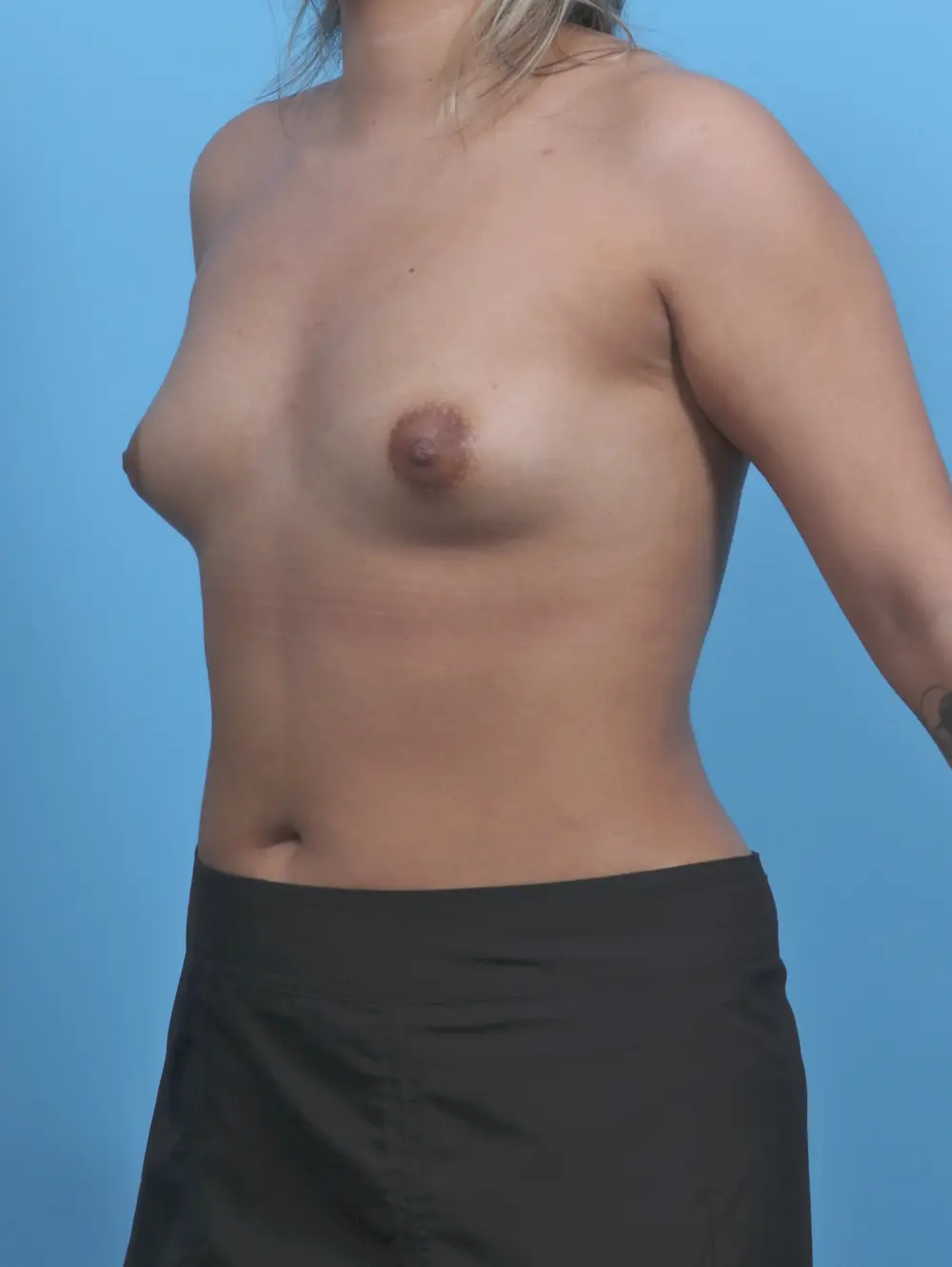Breast Augmentation Patient Photo - Case 51632 - before view-1