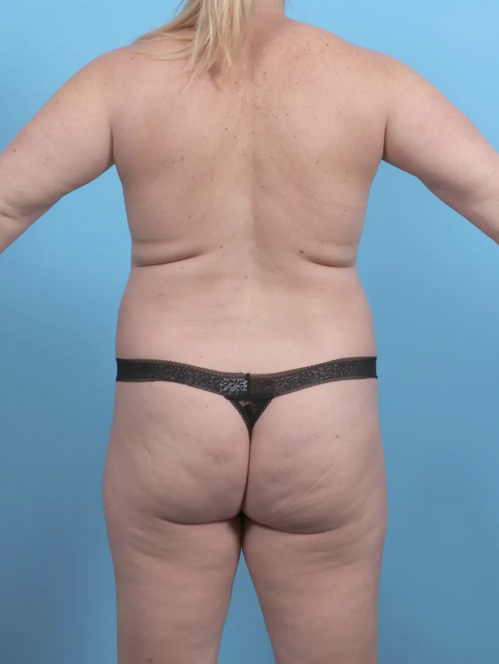 Breast Lift/Reduction with Implants Patient Photo - Case 51656 - before view-3