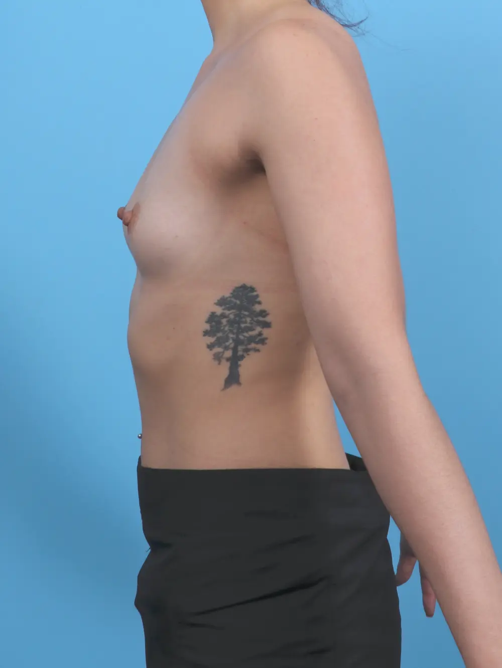 Breast Augmentation Patient Photo - Case 51682 - before view-2