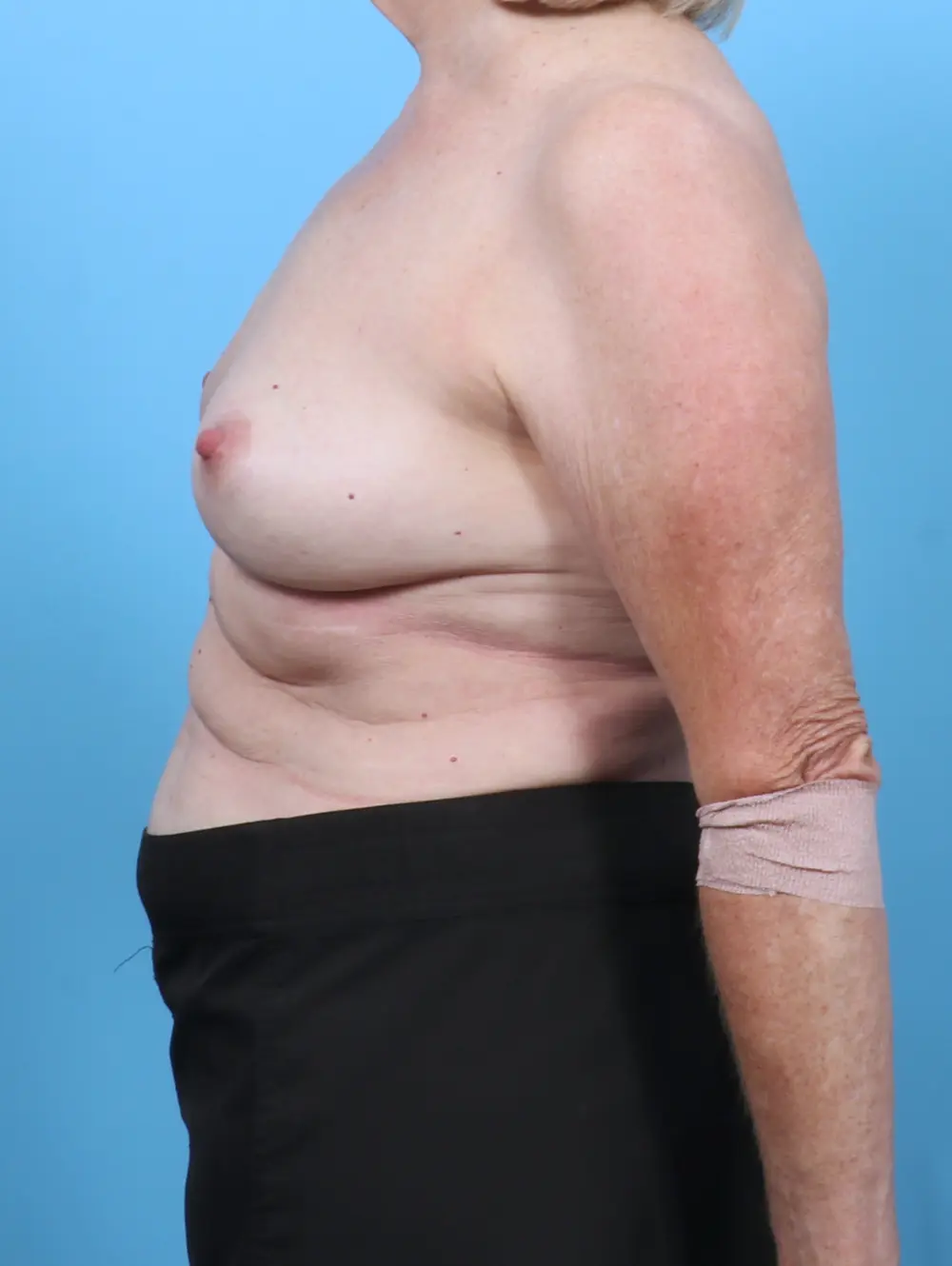 Breast Lift/Reduction w/o Implants Patient Photo - Case 51690 - after view-2