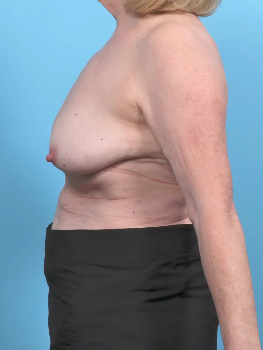 Breast Lift/Reduction w/o Implants Patient Photo - Case 51690 - before view-2