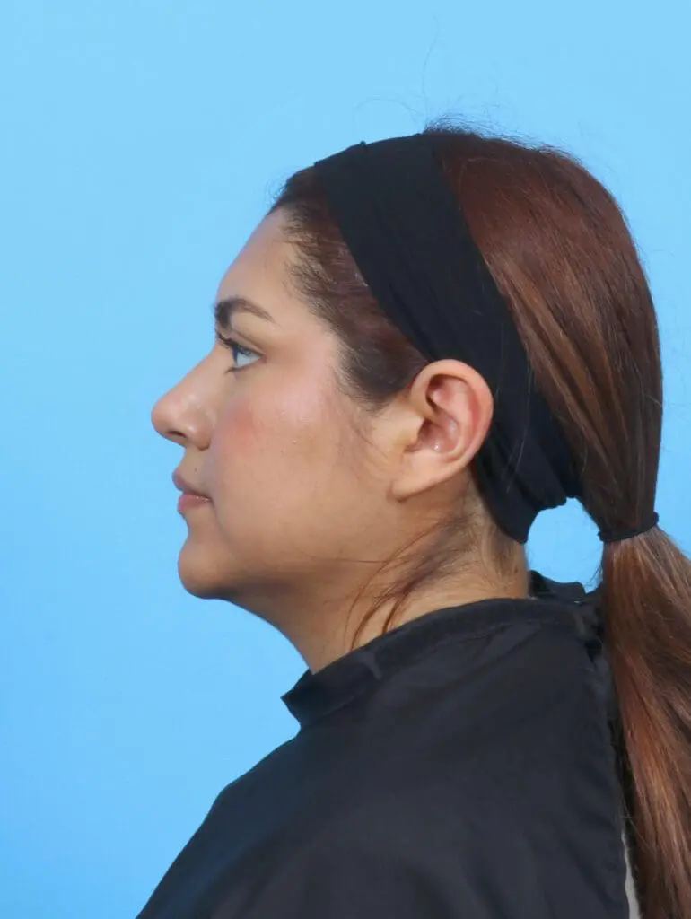 Rhinoplasty - Case 51730 - After