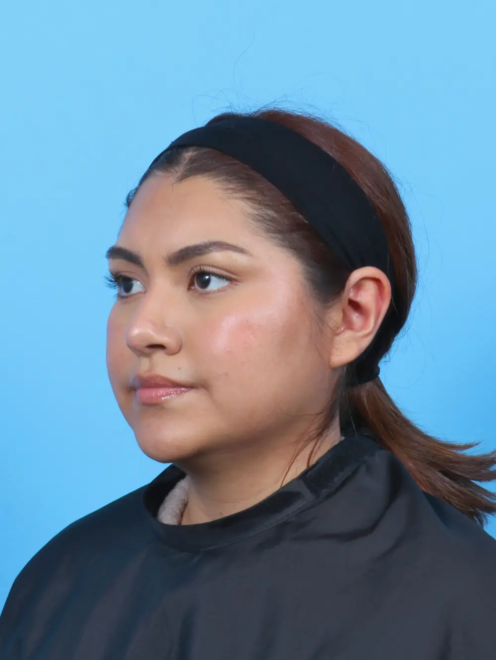Rhinoplasty Patient Photo - Case 51730 - after view-1
