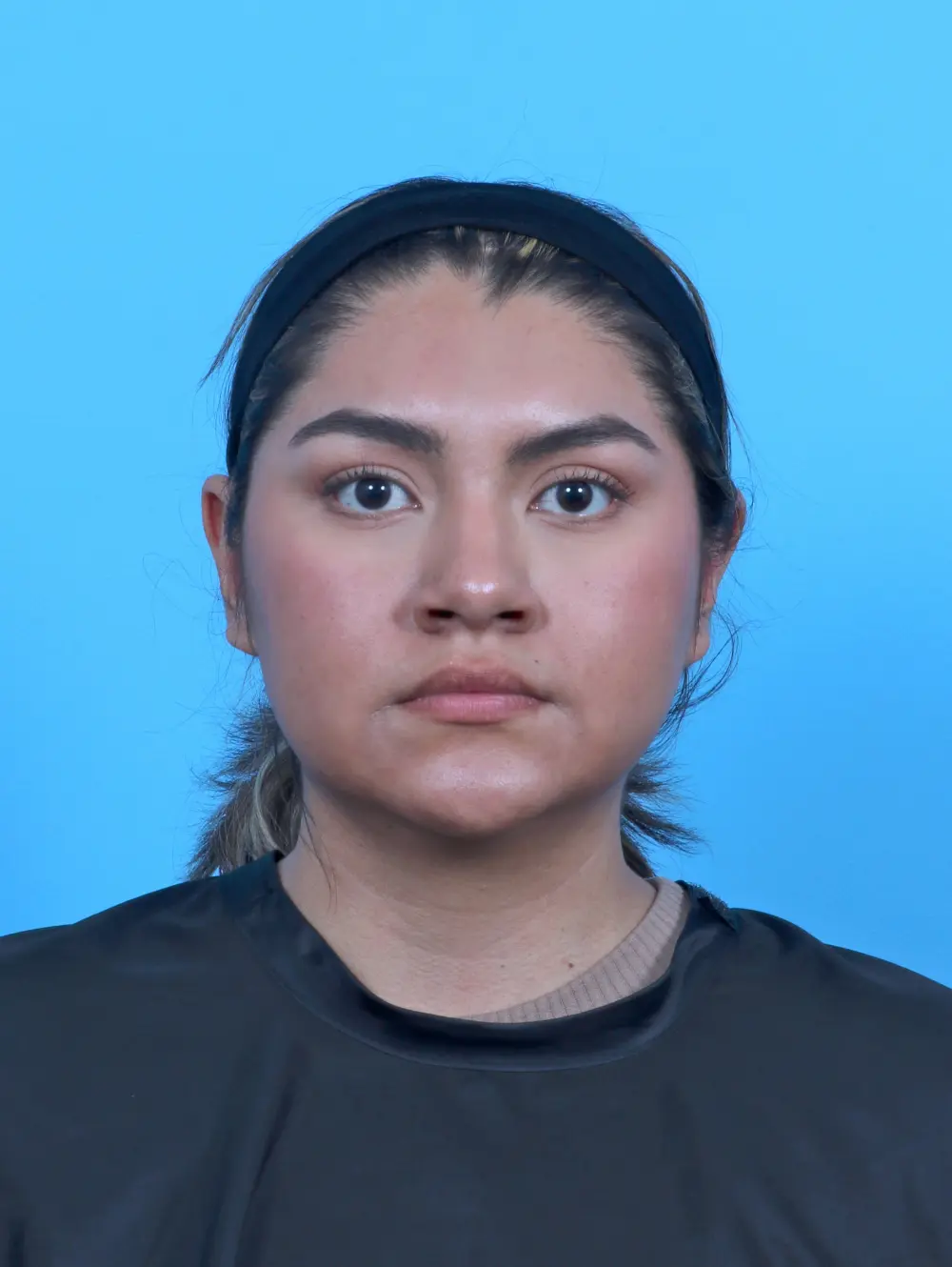 Rhinoplasty Patient Photo - Case 51730 - before view-2