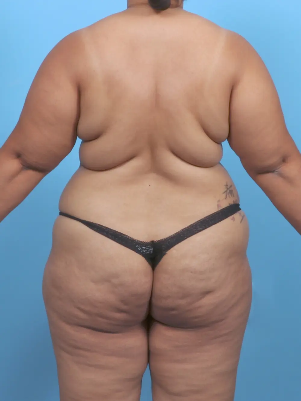 Breast Lift/Reduction w/o Implants Patient Photo - Case 51749 - before view-3